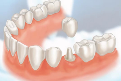 Dental Crowns