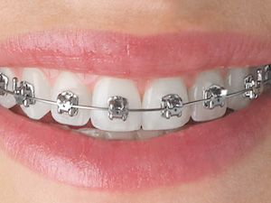 Dental Crowns